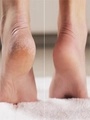 Средство для удаления натоптышей и мозолей PureFeet Keratolytic Intensive IRISK, 30 мл С403-31